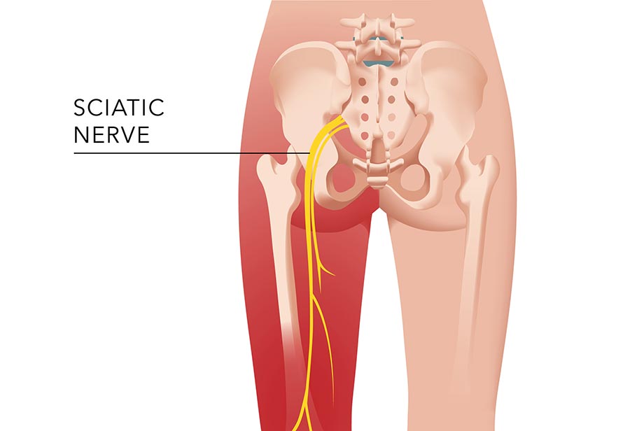 Sciatica chiropractic adjustment - sciatic nerve
